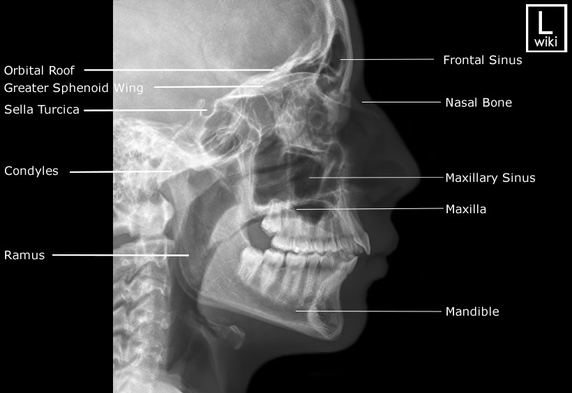 Facial Bones Radiographic Anatomy - wikiRadiography