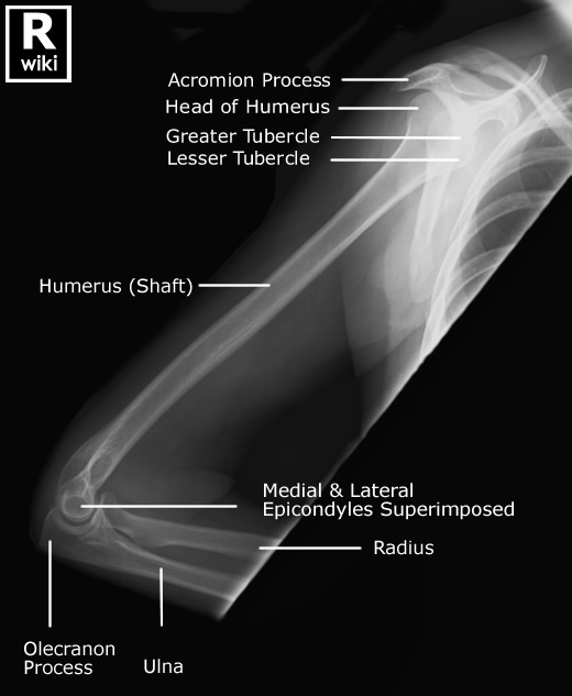 Radiographic Anatomy - Humerus Lateral