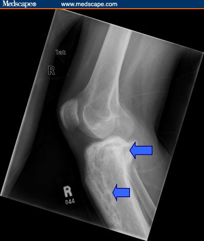 Paget's disease in the proximal tibia