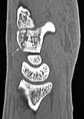hamate fracture CT