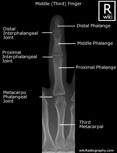 Third (Middle) Finger - AP - Radiographic Anatomy