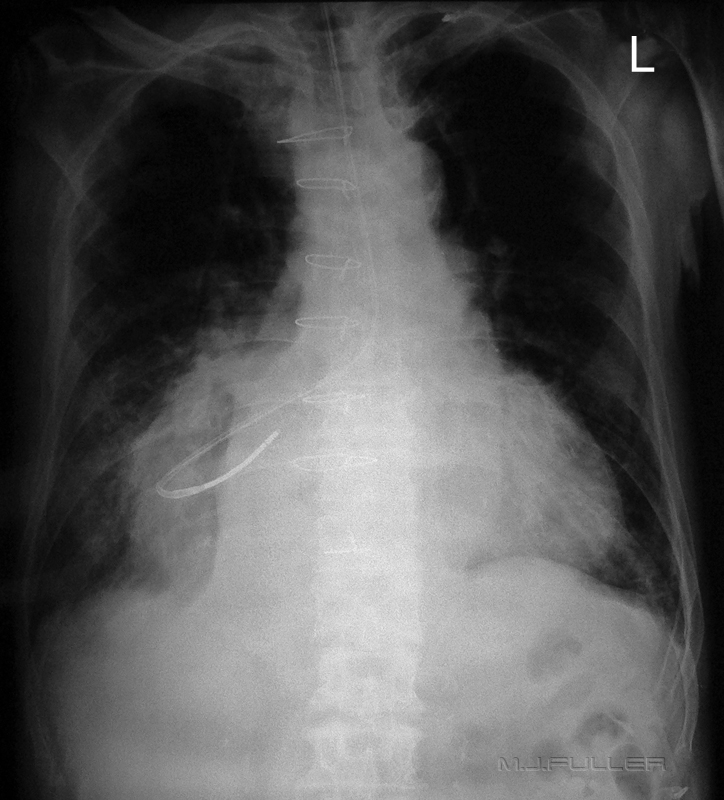 Nasogastric Tube Position Confirmation - wikiRadiography