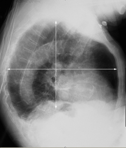COPD lateral chest