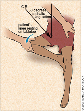 modified trauma lateral hip
