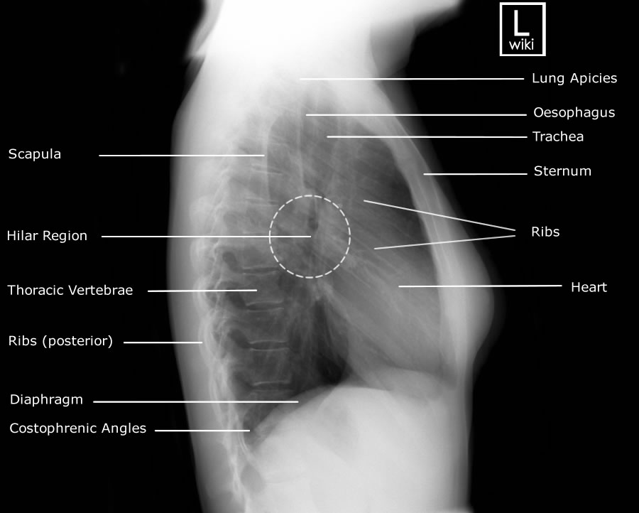 Adult Chest - Lateral - Radiographic Anatomy