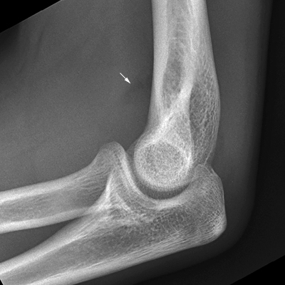 LATERAL ELBOW