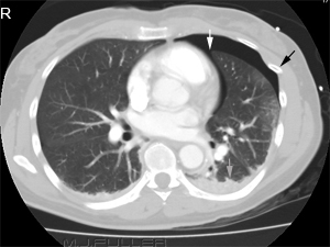 Supine Pneumothorax Self-test Page - wikiRadiography