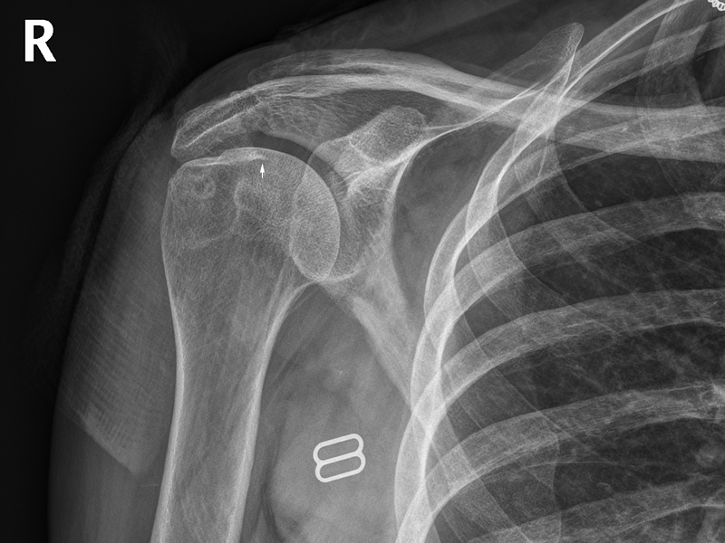 acromial Fracture