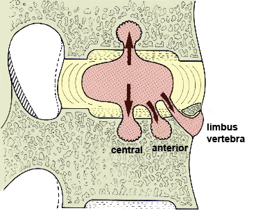 limbus vertebra