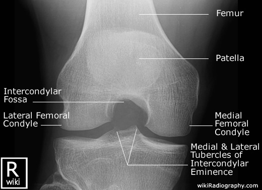 Radiographic Anatomy - Knee - Intercondylar