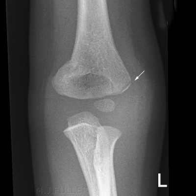 Lateral Condylar Elbow Fractures - wikiRadiography