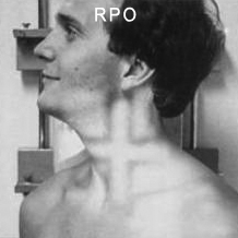 RPO cervical spine