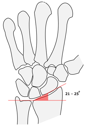 radial inclination