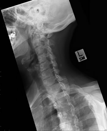 Cervical Spine Oblique - Markers - wikiRadiography