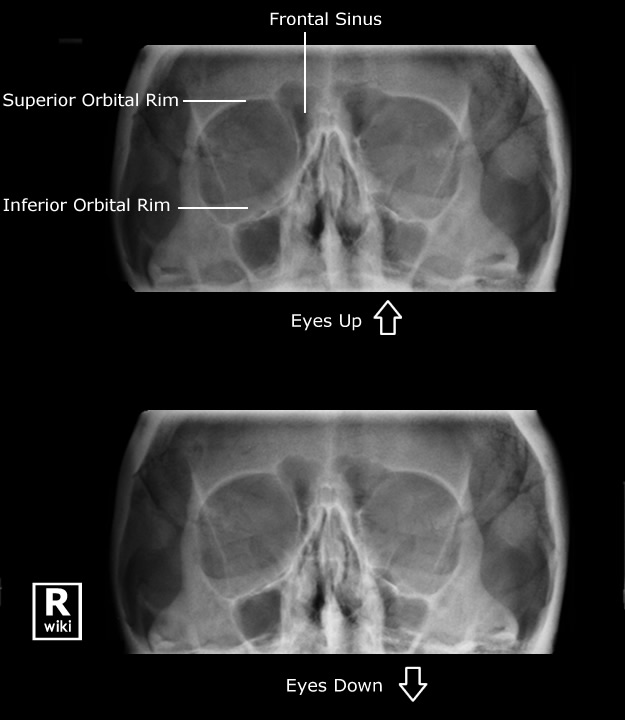 Radiographic Anatomy - Orbits eyes up/eyes down