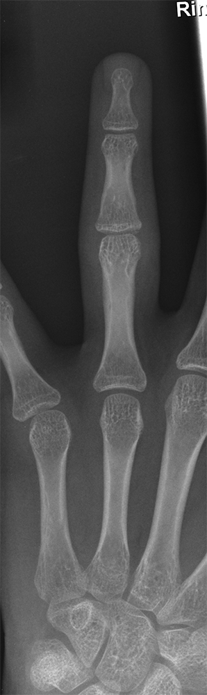 finger volar plate fracture