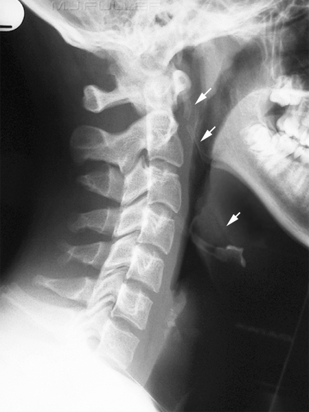 stylohyoid ligament calcification