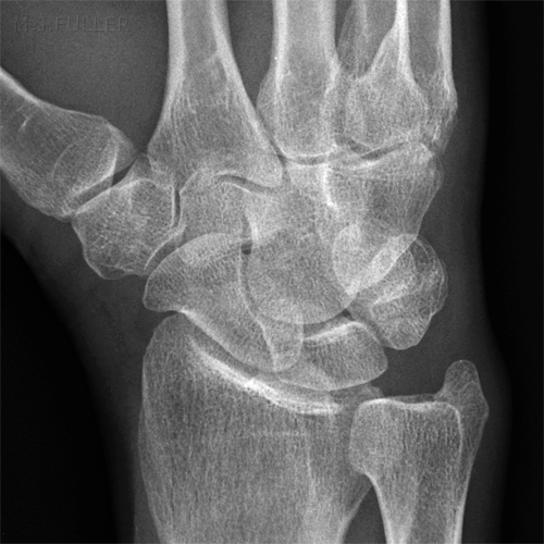 HAMATE FRACTURE obl