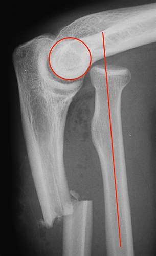 The Paediatric Elbow - wikiRadiography