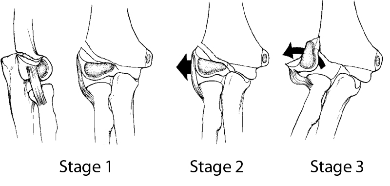 classification of lateral condyle fractures