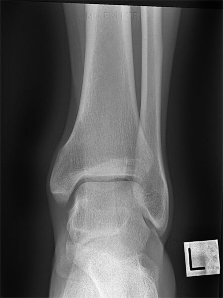 NORMAL ANKLE SOFT TISSUES
