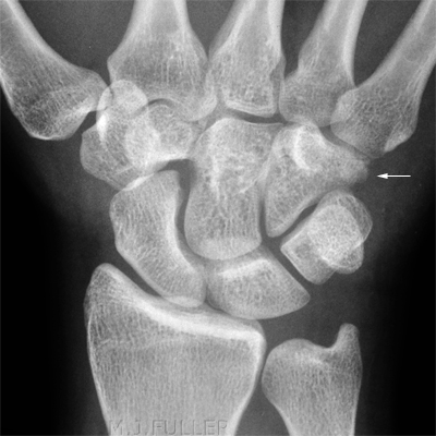 HAMATE FRACTURE