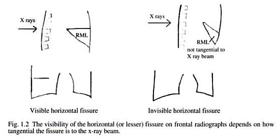 horizontal fissure