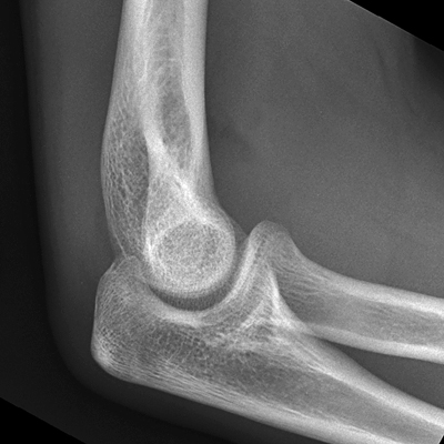 lateral elbow