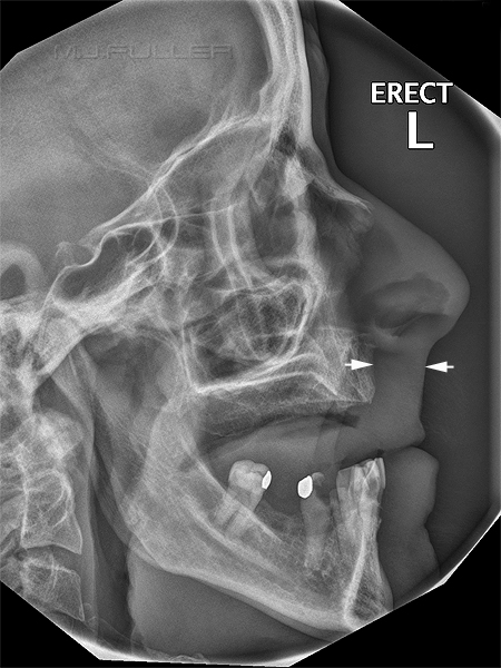lateral facial bones DR1