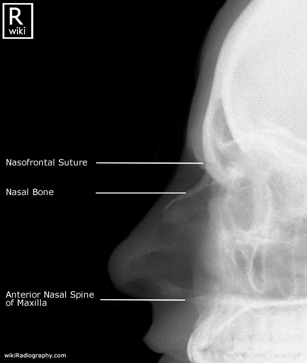 Nasal Bones Radiographic Anatomy - wikiRadiography