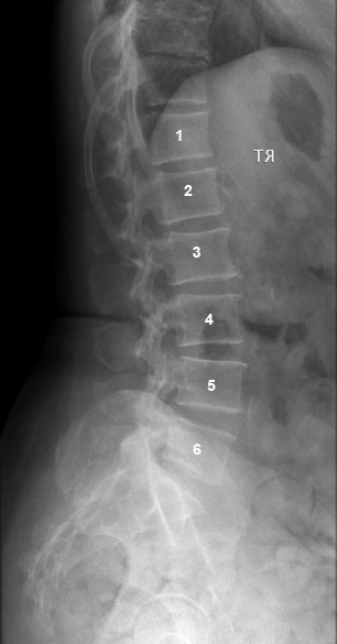 transitional vertebra