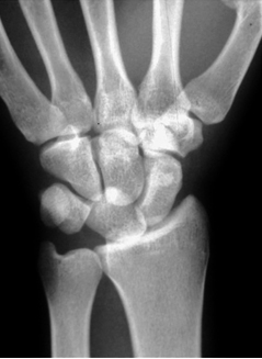 Lunate and Perilunate Dislocations - wikiRadiography