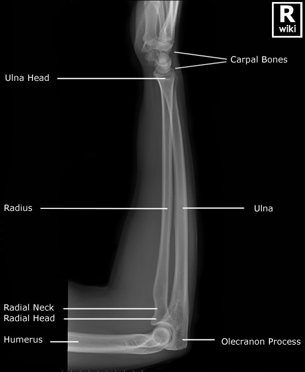 Radiographic Anatomy - Forearm Lateral
