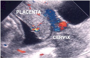 Placenta Previa.JPG (22745 bytes)