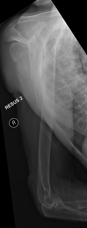 Neck of Humerus Fractures - wikiRadiography