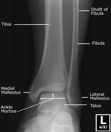 Radiographic Anatomy - Ankle Mortise