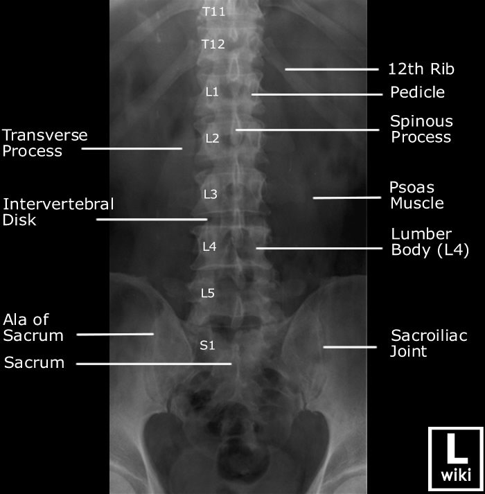Radiographic Anatomy - Lumber Spine AP