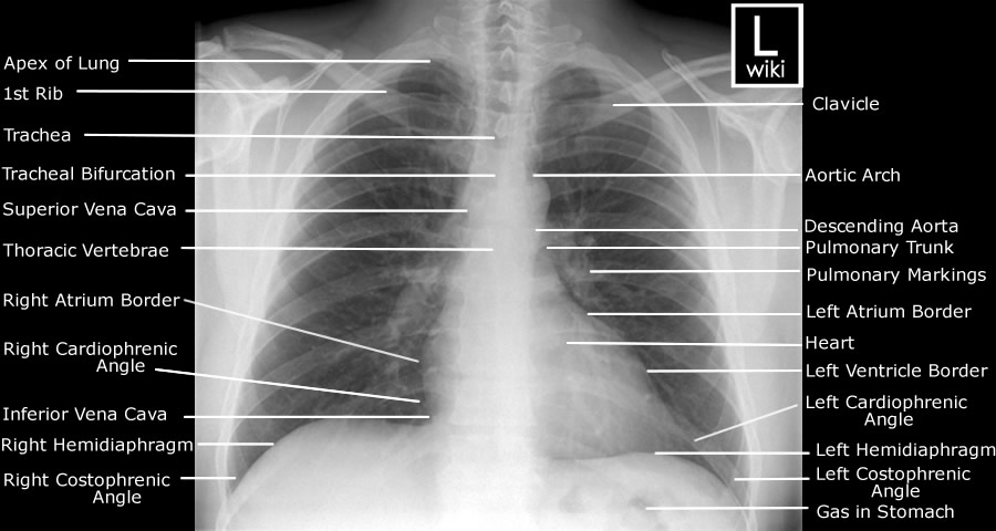 Chest Radiographic Anatomy - wikiRadiography