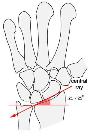 radial inclination