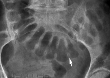 The Abdominal Plain Film- Differentiating Large and Small Bowel - wikiRadiography