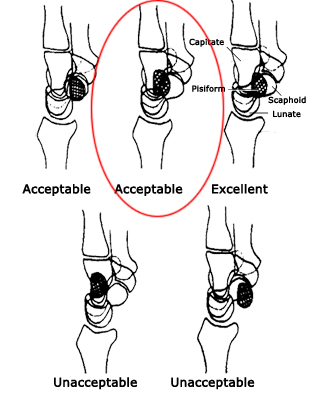 lateral wrist