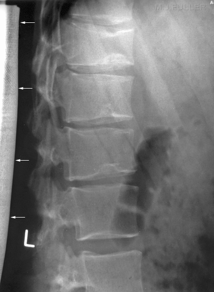 lateral lumbar spine- lead rubber