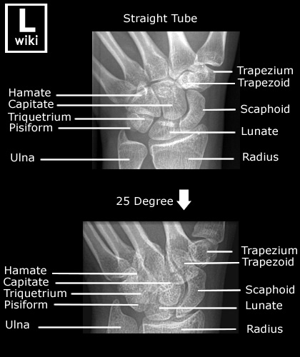 Radiographic Anatomy - Wrist Scaphoid