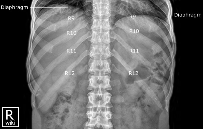 Ribs Radiographic Anatomy - wikiRadiography