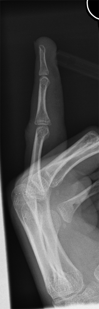 volar plate fracture