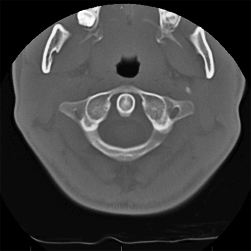 axial CT cervical spine