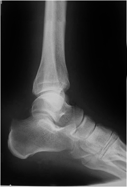 BASE 5TH MT FRACTURE