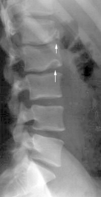 limbus vertebra