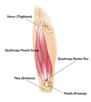 quadriceps tendon rupture