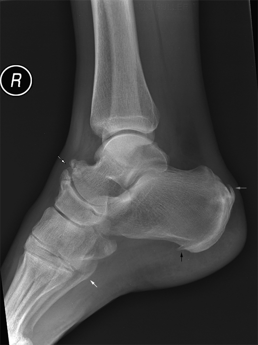 Lateral ankle
